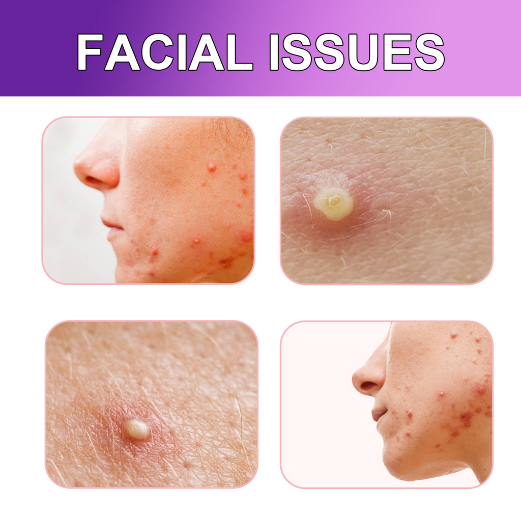 Acne Patches Lighten Facial Acne, Close Mouth Care And Balance Delicate Skin Pores Patch